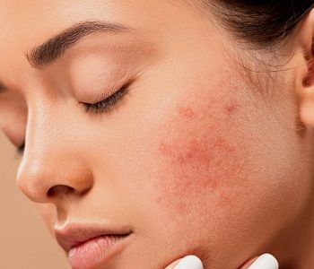 Tipy a rady proti akné - ako sa ho zbaviť? (Foto: pixabay.com)