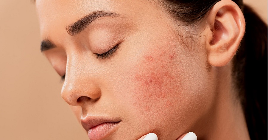 Tipy a rady proti akné - ako sa ho zbaviť? (Foto: pixabay.com)